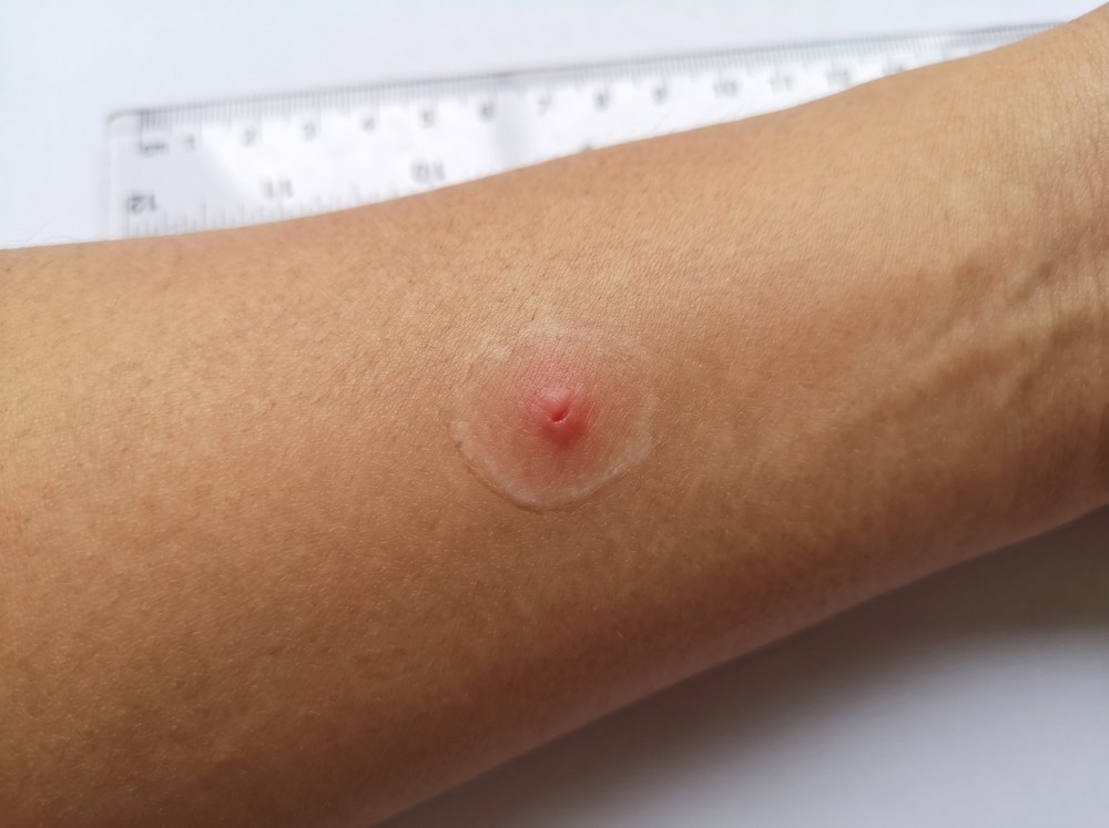 Close-up of a fresh black widow bite mark showing two faint puncture points surrounded by a pale halo of skin